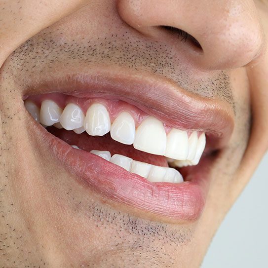 Teeth Whitening During Orthodontic Treatment? - MyOrthodontist - teeth whitening,teeth whitening near me,orthodontist teeth whitening near me orthodontist